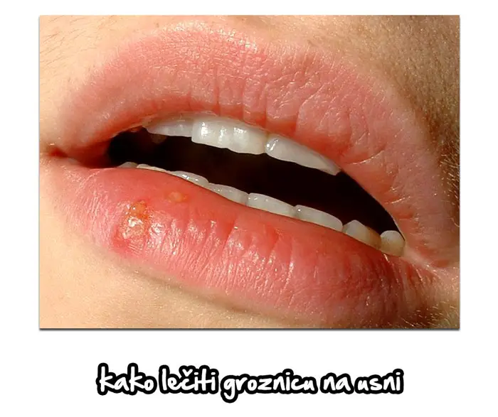kako leciti groznicu na usni